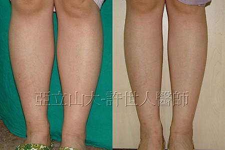 羅丹轉世? <全方位抽脂達人的誕生> 64 7.小腿環抽