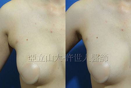 羅丹轉世? <全方位抽脂達人的誕生> 65 8.副乳