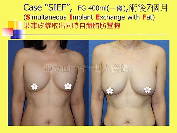 羅丹轉世? <全方位抽脂達人的誕生> 70 SIEF 自體脂肪隆乳 7個月 1