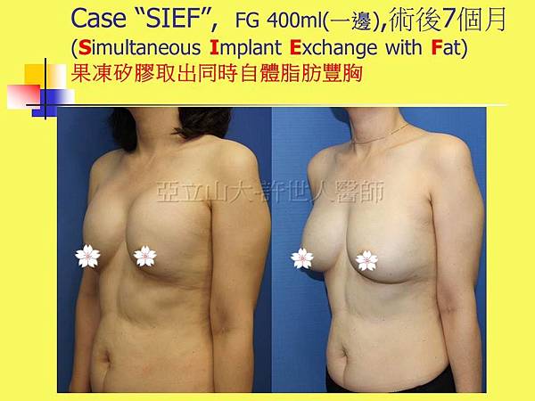 羅丹轉世? <全方位抽脂達人的誕生> 72 SIEF 自體脂肪隆乳 7個月 3