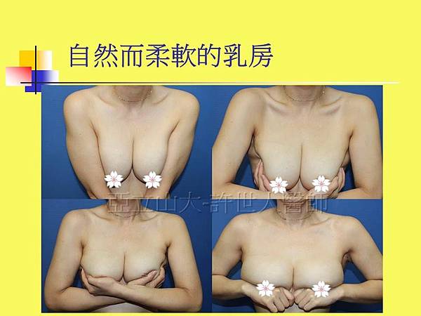 羅丹轉世? <全方位抽脂達人的誕生> 73 SIEF 自體脂肪隆乳 7個月 4