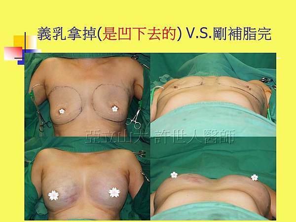 羅丹轉世? <全方位抽脂達人的誕生> 74 SIEF 自體脂肪隆乳 7個月 5