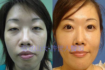 羅丹轉世? <全方位抽脂達人的誕生> 66 a.全臉脂肪注射回春 1