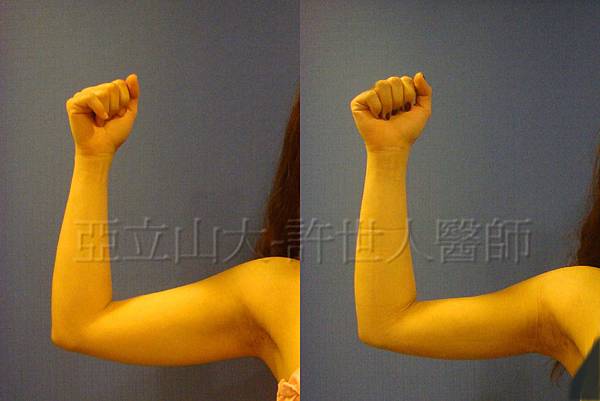 羅丹轉世? <全方位抽脂達人的誕生> 25 a.手臂 威塑VASER抽脂 3