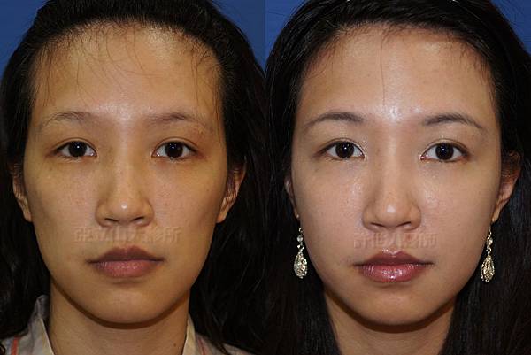 羅丹轉世? <全方位抽脂達人的誕生> 68 b.全臉脂肪注射回春 2