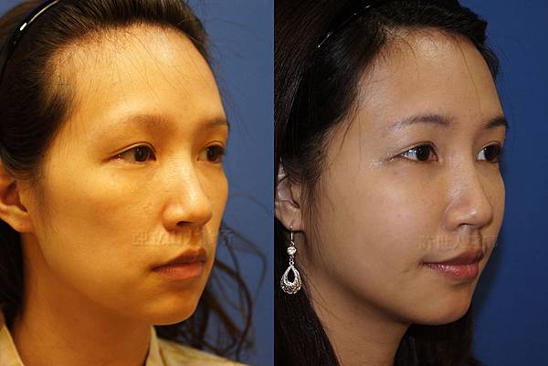 羅丹轉世? <全方位抽脂達人的誕生> 69 b.全臉脂肪注射回春 3