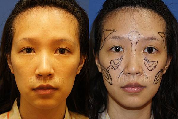 羅丹轉世? <全方位抽脂達人的誕生> 67 b.全臉脂肪注射回春