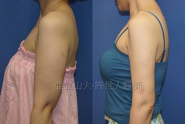 羅丹轉世? <全方位抽脂達人的誕生> 26 b.手臂 威塑VASER抽脂 1