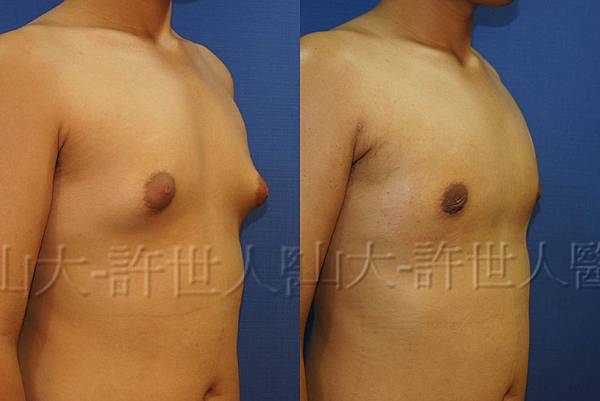 羅丹轉世? <全方位抽脂達人的誕生> 32 b.男性女乳症 1