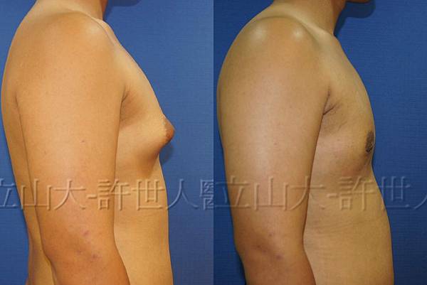 羅丹轉世? <全方位抽脂達人的誕生> 33 b.男性女乳症 2