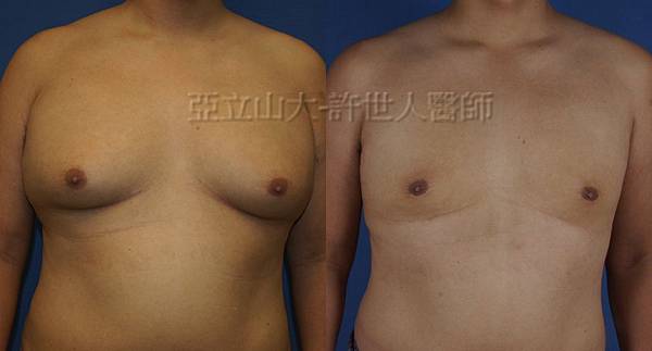 羅丹轉世? <全方位抽脂達人的誕生> 34 c.男性女乳症 1