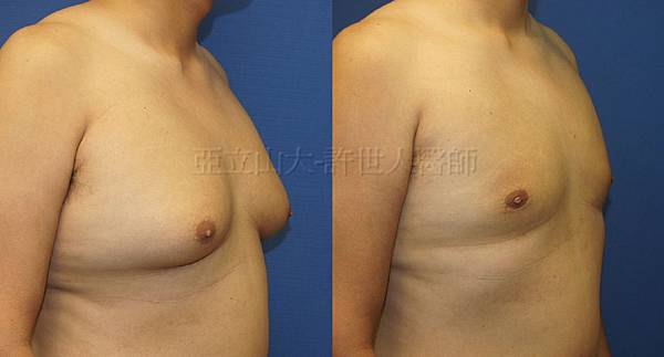 羅丹轉世? <全方位抽脂達人的誕生> 35 c.男性女乳症 2