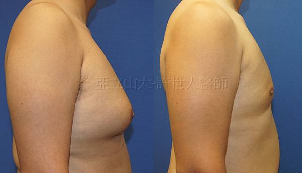 羅丹轉世? <全方位抽脂達人的誕生> 36 c.男性女乳症 3