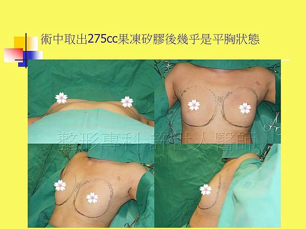 羅丹轉世? <全方位抽脂達人的誕生> 90 d.SIEF 4