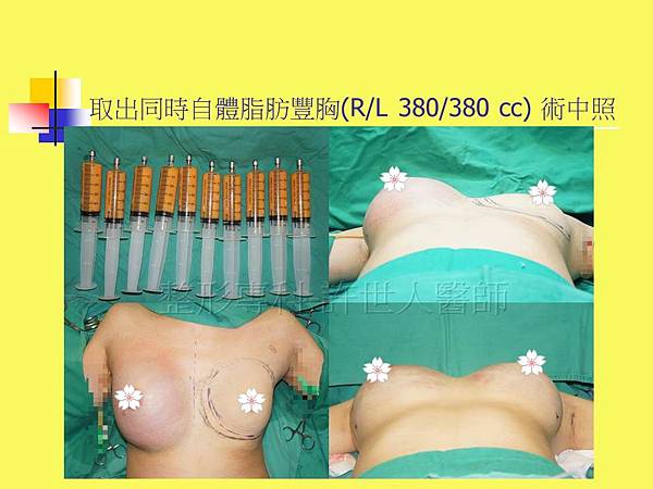 羅丹轉世? <全方位抽脂達人的誕生> 91 d.SIEF 5