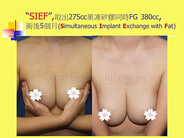 羅丹轉世? <全方位抽脂達人的誕生> 92 d.SIEF 6