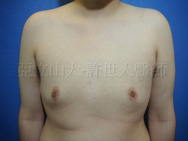 羅丹轉世? <全方位抽脂達人的誕生> 31 男性女乳症 002