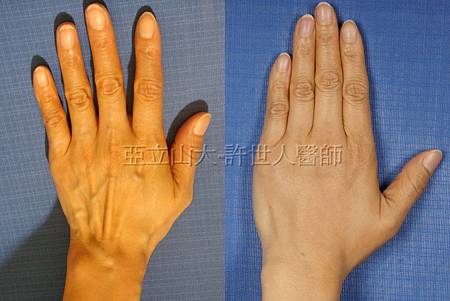 羅丹轉世? <全方位抽脂達人的誕生> 102 雞爪手整形 1