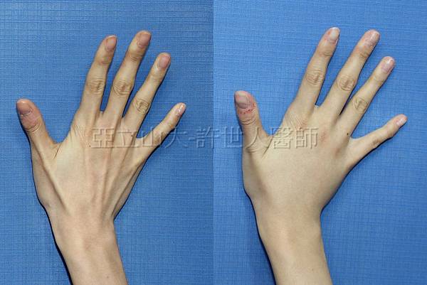 羅丹轉世? <全方位抽脂達人的誕生> 103 雞爪手整形 2