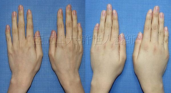 羅丹轉世? <全方位抽脂達人的誕生> 104 雞爪手整形 3