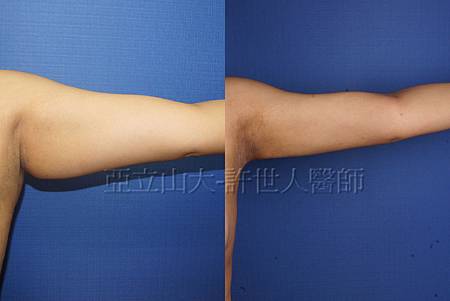 案例分享手臂環抽後大腿抽脂自體脂肪隆乳 術後 10
