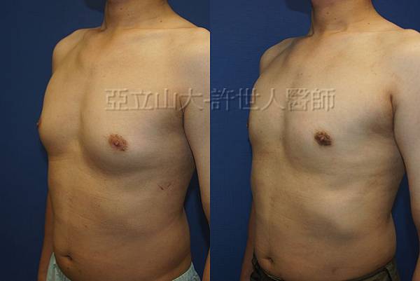 「你是我胸口永遠的痛」? 倘開心胸談「男性女乳症」! 164 男性女乳症 許世人醫師分享