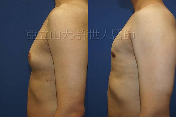 「你是我胸口永遠的痛」? 倘開心胸談「男性女乳症」! 165 男性女乳症 許世人醫師分享