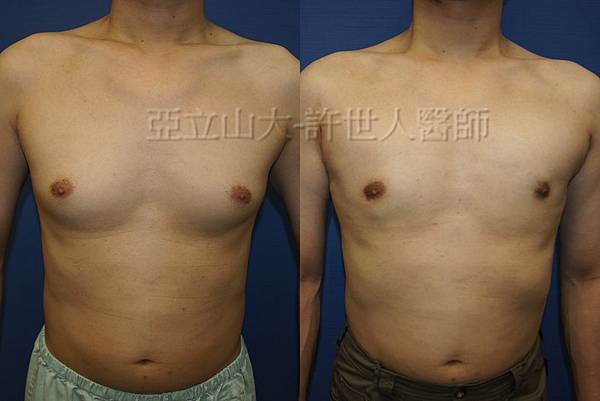 「你是我胸口永遠的痛」? 倘開心胸談「男性女乳症」! 163 男性女乳症 許世人醫師分享