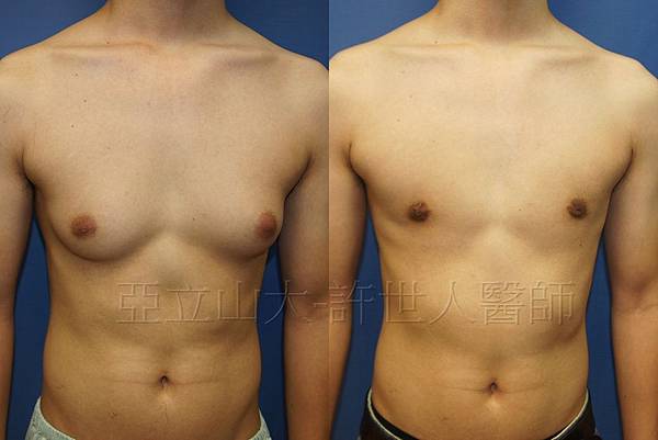 「你是我胸口永遠的痛」? 倘開心胸談「男性女乳症」! 152 男性女乳症世人醫師案例