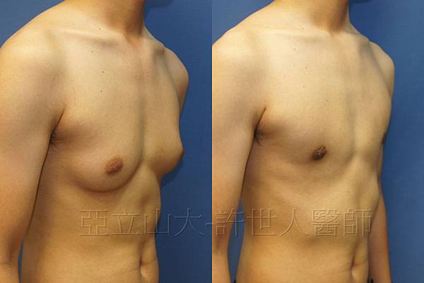 「你是我胸口永遠的痛」? 倘開心胸談「男性女乳症」! 153 男性女乳症-許世人醫師案例-2