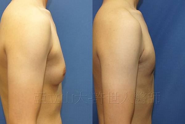 「你是我胸口永遠的痛」? 倘開心胸談「男性女乳症」! 154 男性女乳症-許世人醫師案例-3