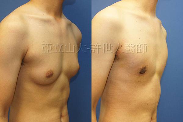 「你是我胸口永遠的痛」? 倘開心胸談「男性女乳症」! 158 男性女乳症 許世人醫師案例 術前和術後7天比較 2