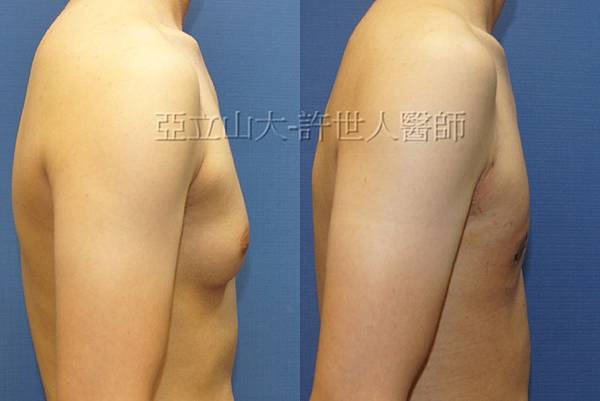 「你是我胸口永遠的痛」? 倘開心胸談「男性女乳症」! 159 男性女乳症 許世人醫師案例 術前和術後7天比較 3