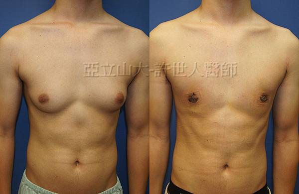 「你是我胸口永遠的痛」? 倘開心胸談「男性女乳症」! 157 男性女乳症 許世人醫師案例 術前和術後7天比較