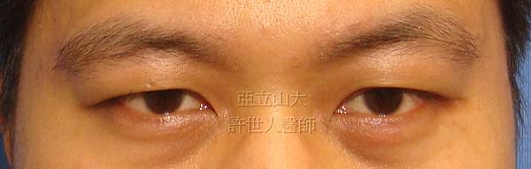 讓你一次逆齡年輕20歲的內視鏡五爪鈎前額拉皮提眉術