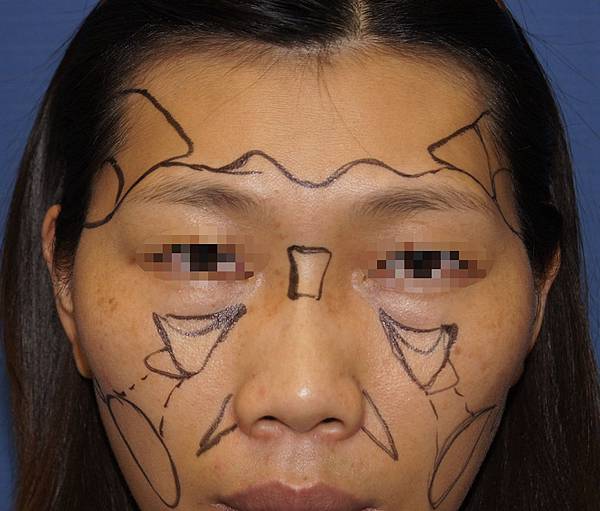 自體脂肪雕塑額頭、太陽穴、蘋果肌、淚溝、臉頰、山根 1