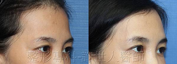 體脂肪雕塑額頭、太陽穴、蘋果肌、淚溝、臉頰） 5