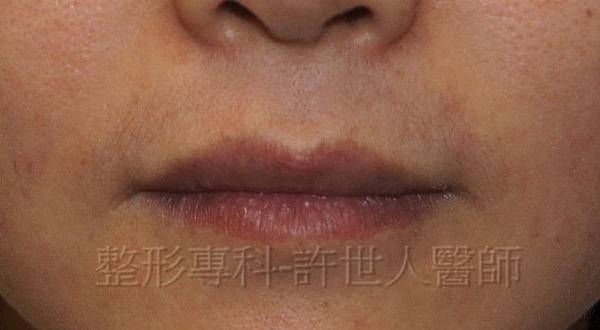 2-微笑嘴唇(上唇)-1