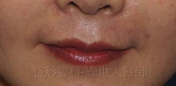 2-微笑嘴唇(上唇)-2