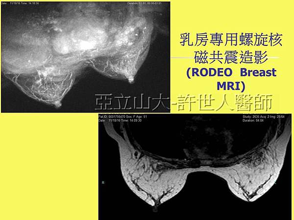 自體脂肪隆乳豐胸_乳房專用螺旋核磁共震造影