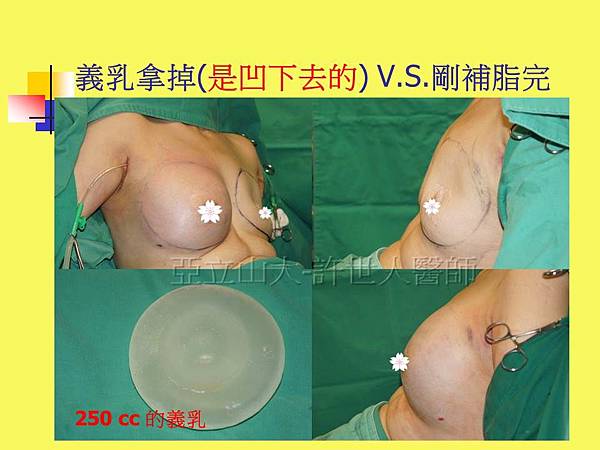 義乳拿掉V.S.剛補脂完