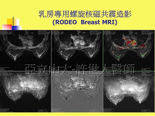 自體脂肪隆乳豐胸_乳房專用螺旋核磁共震造影