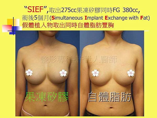 SIEF-果凍矽膠V.S.自體脂肪-1