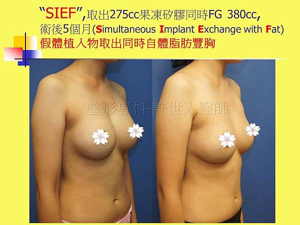 SIEF-果凍矽膠V.S.自體脂肪隆乳