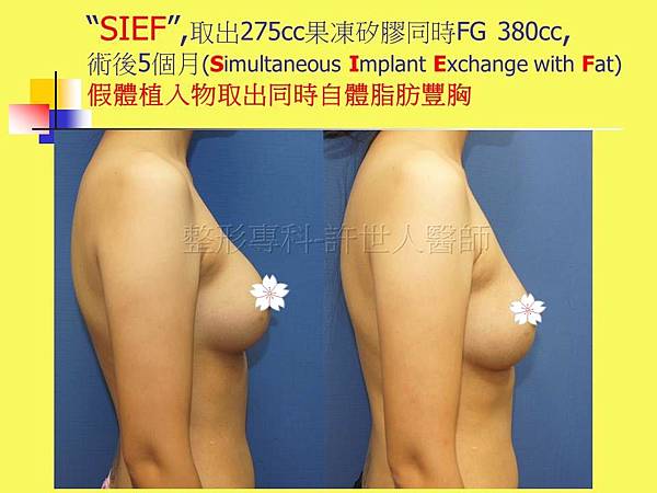 SIEF-果凍矽膠V.S.自體脂肪-3