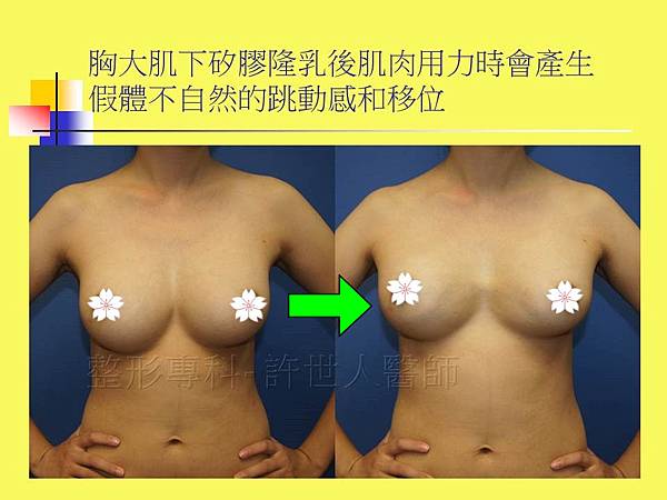 SIEF-自體脂肪豐胸後乳房呈現自然柔軟的狀態-2