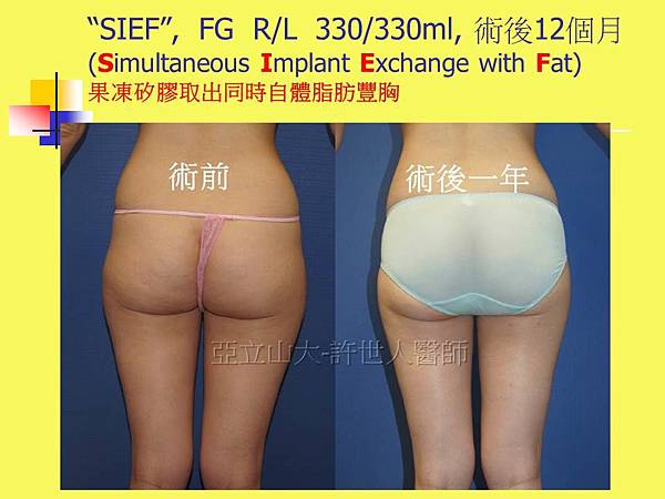 果凍矽膠取出同時自體脂肪隆乳豐胸 術後12個月比對圖