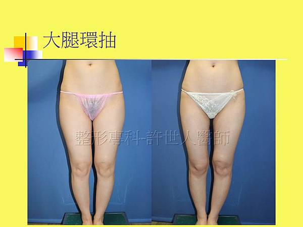 大腿環抽脂-1