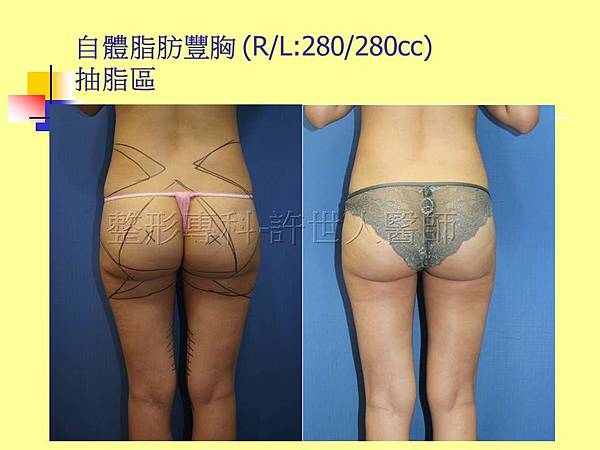 案例-自體脂肪豐胸-抽脂區-2