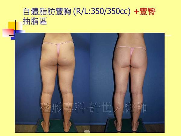 案例-自體脂肪豐胸-術後18個月-05